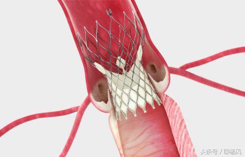 我院成功实施首例经导管主动脉瓣置换术（TAVR）